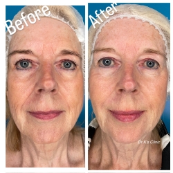 Full face rejuvenations