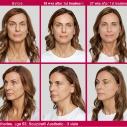 What is Sculptra?